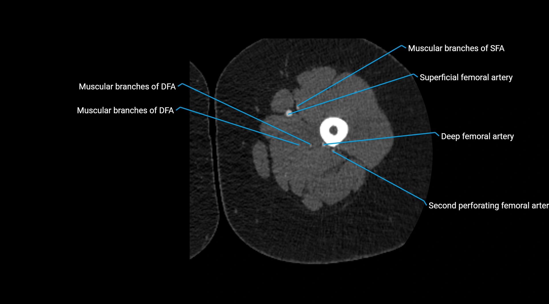 CTA lower limb cross sectional anatomy labelled image _112.webp